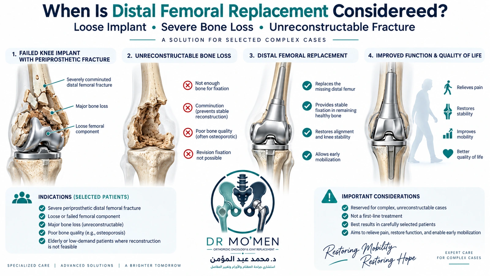 When Is Distal Femoral Replacement Considered? Medical infographic showing distal femoral replacement as a reconstruction option for severe periprosthetic knee fractures with major bone loss.