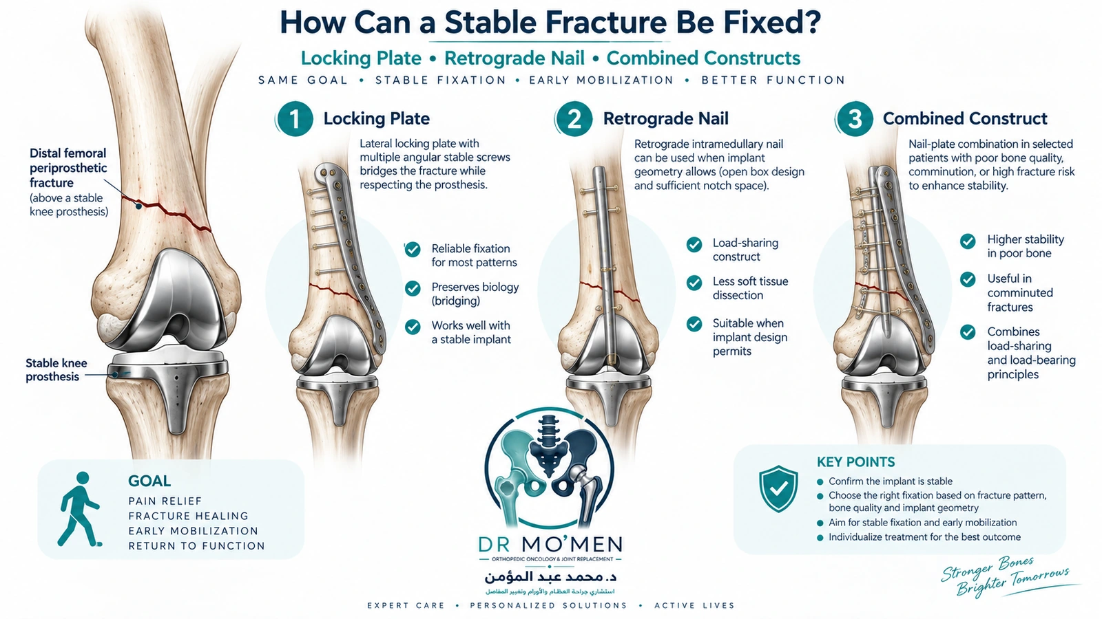 How Can a Stable Fracture Be Fixed? Medical infographic explaining plate, retrograde nail and combined fixation options for fractures above a stable knee replacement.