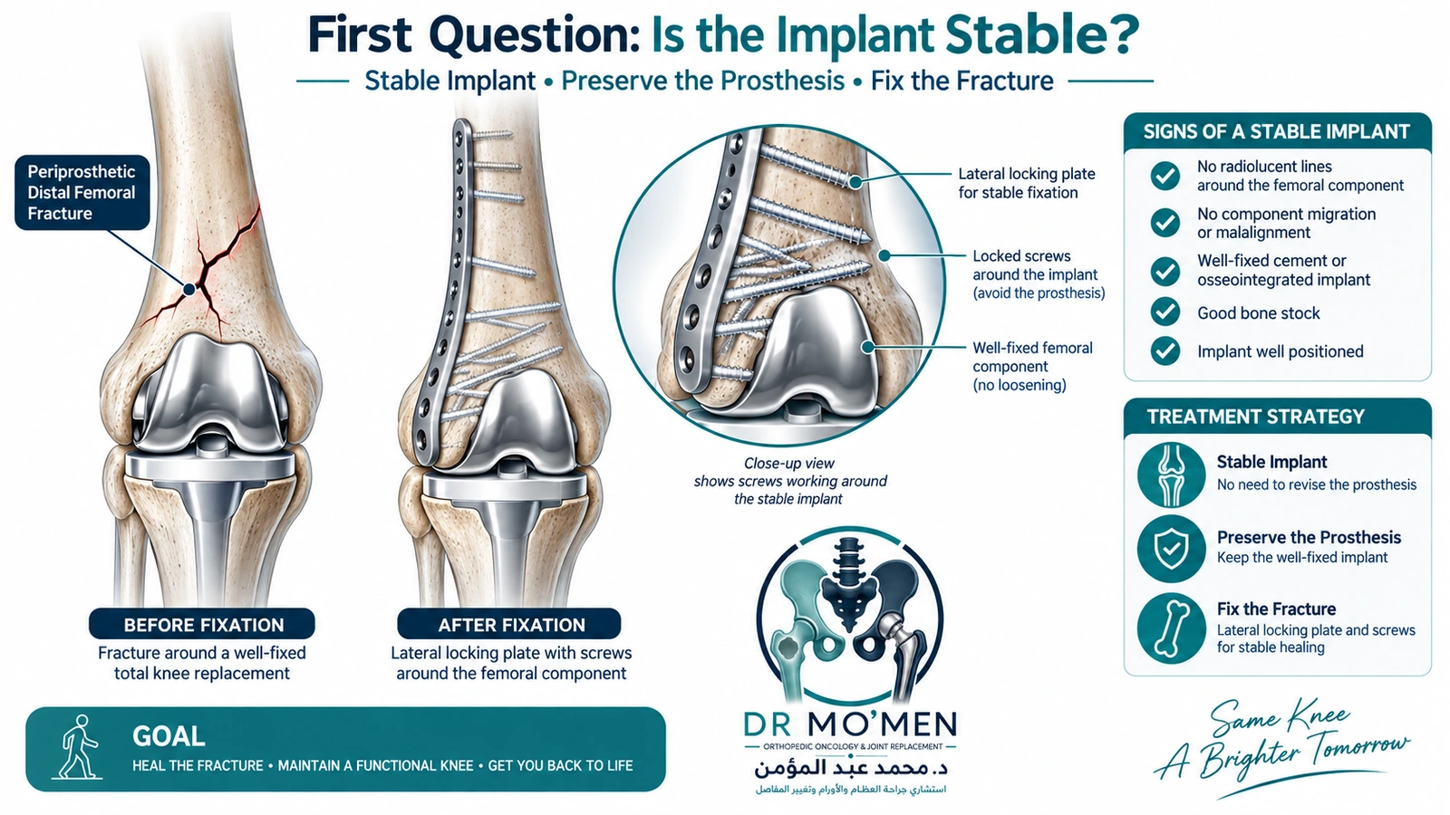 First Question: Is the Implant Stable? Medical illustration showing locking plate fixation of a periprosthetic distal femoral fracture around a stable knee replacement.