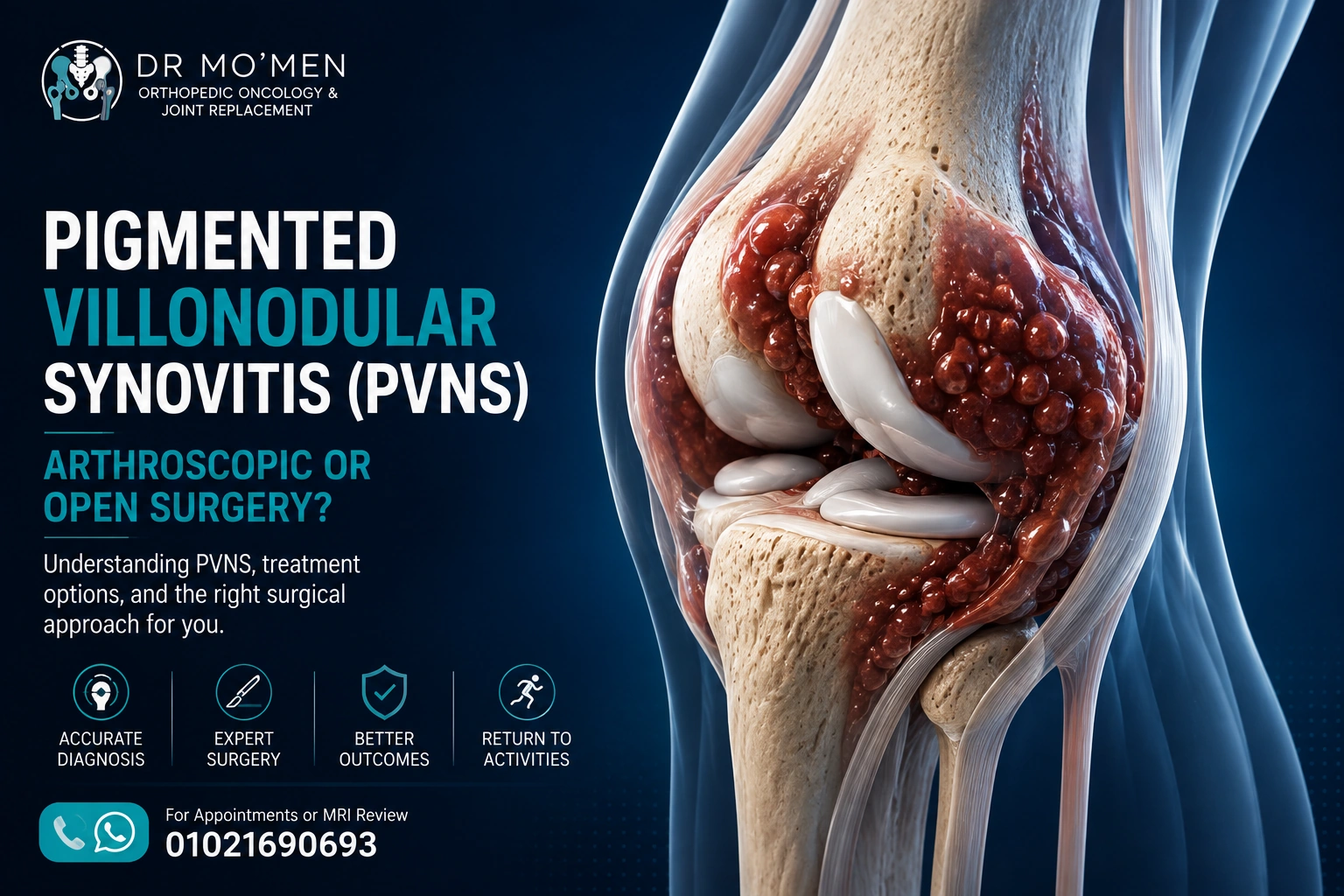 3D knee illustration showing PVNS/TGCT and arthroscopic versus open surgery