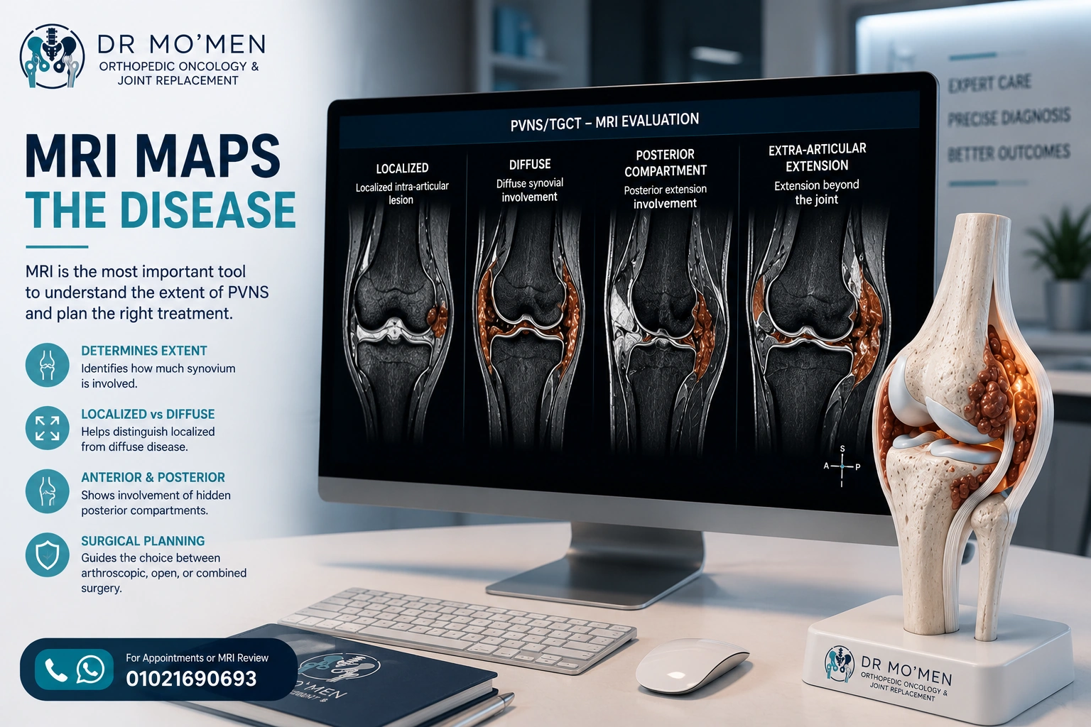 MRI evaluation of knee PVNS/TGCT showing localized, diffuse, posterior and extra-articular disease patterns for treatment planning.