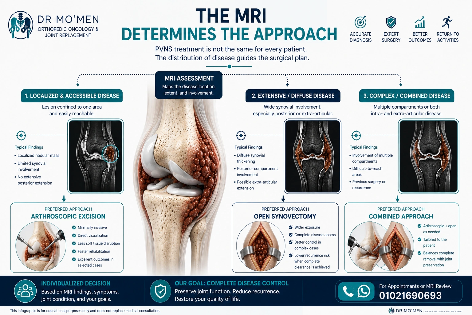 MRI-based treatment decision pathway for localized, diffuse and complex knee PVNS/TGCT using arthroscopic, open or combined surgery.