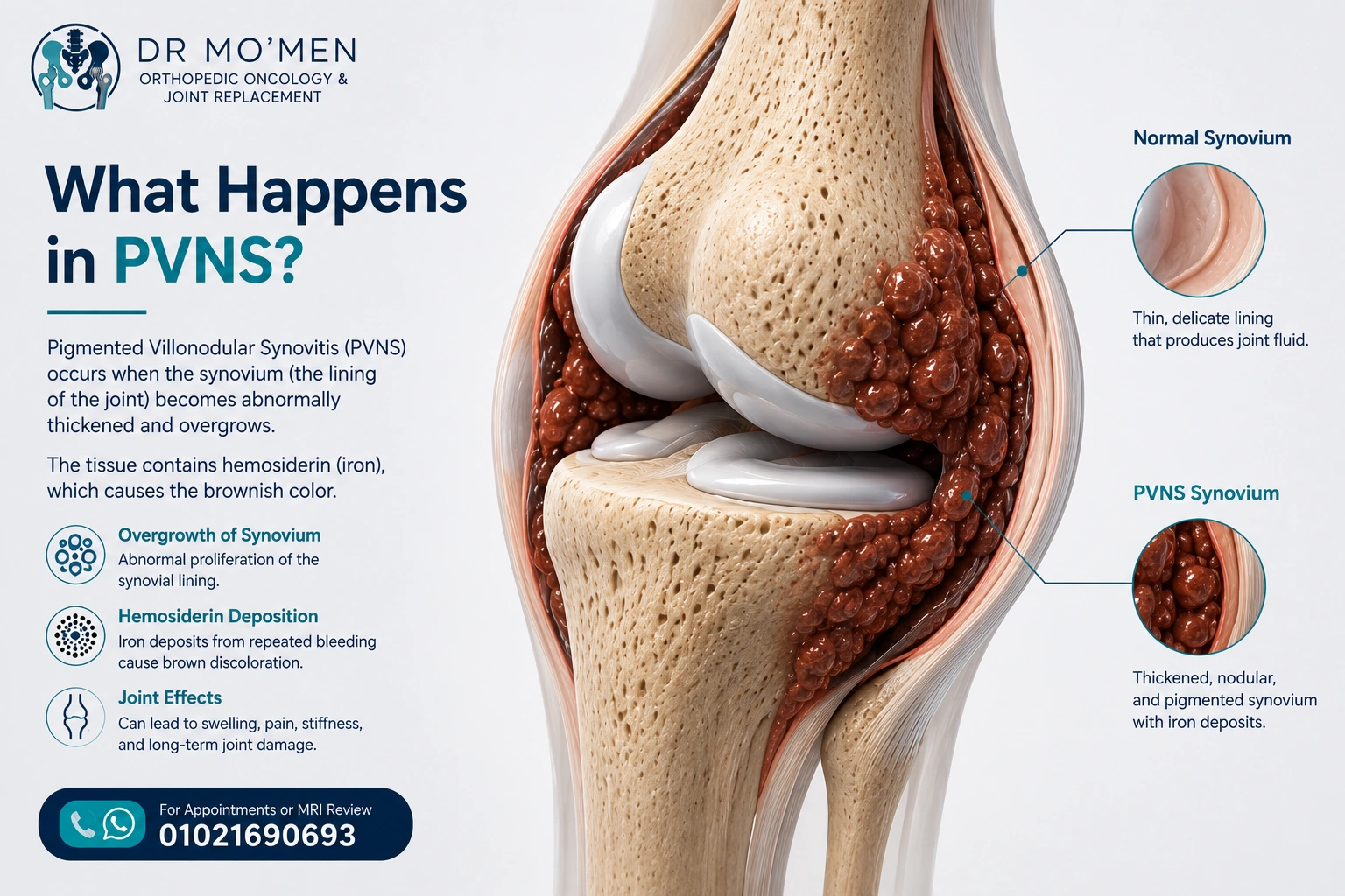 Educational 3D illustration comparing normal synovium with thickened hemosiderin-rich PVNS/TGCT synovium in the knee.