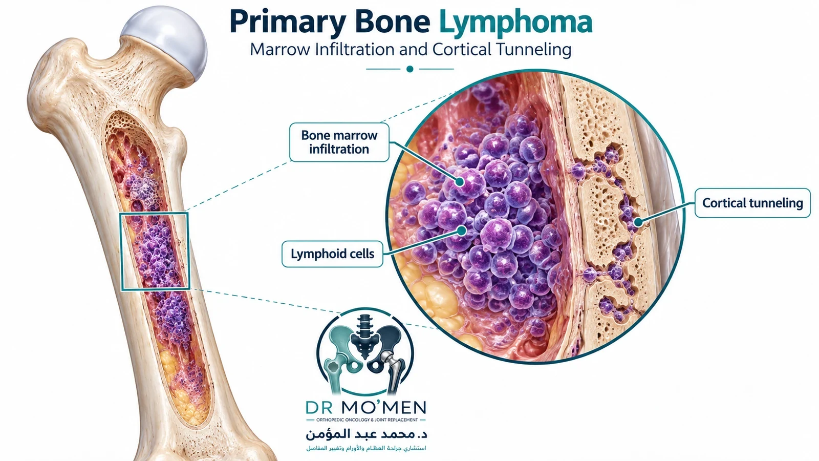 Educational anatomical cutaway of femur with lymphoid marrow infiltration and cortical change; illustration, not a patient specimen.