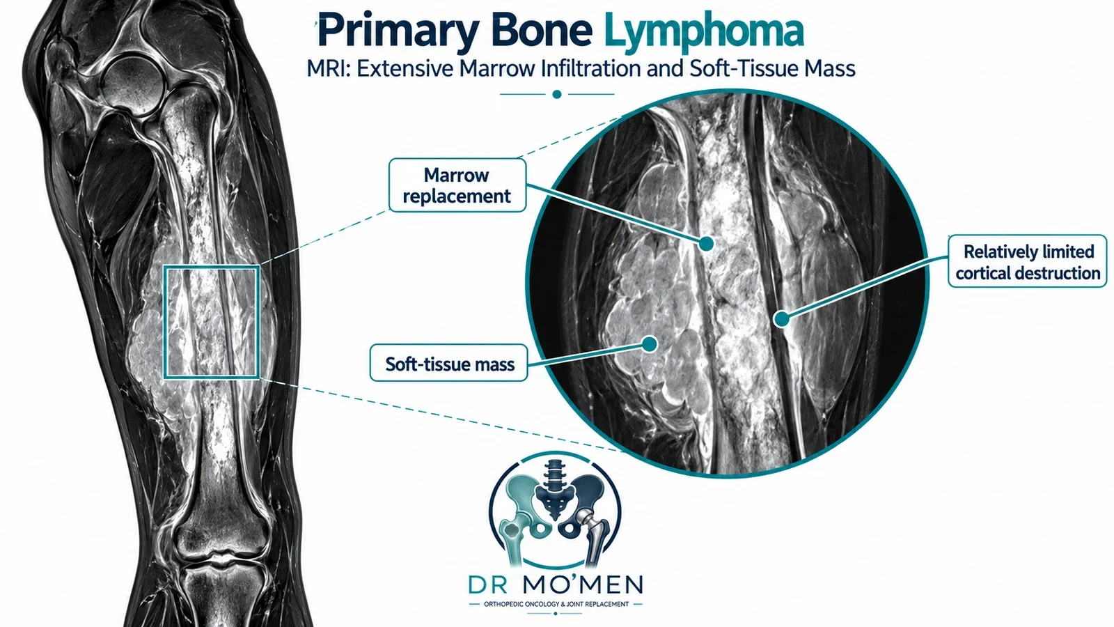 AI-generated MRI-style educational illustration of marrow infiltration and a soft-tissue mass; not a patient MRI scan.