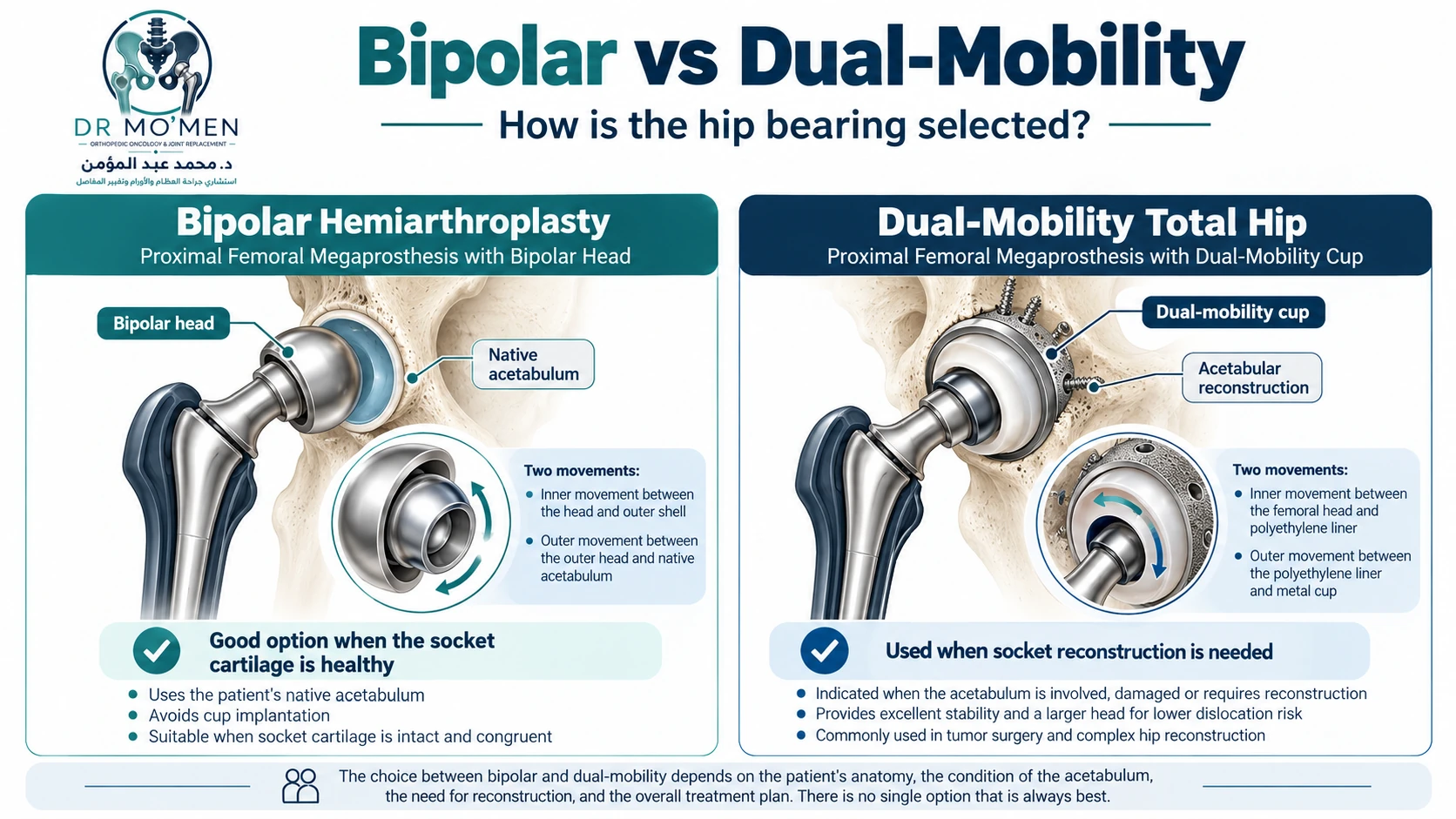 Educational comparison of bipolar hemiarthroplasty and dual-mobility total hip articulation in proximal femoral replacement.