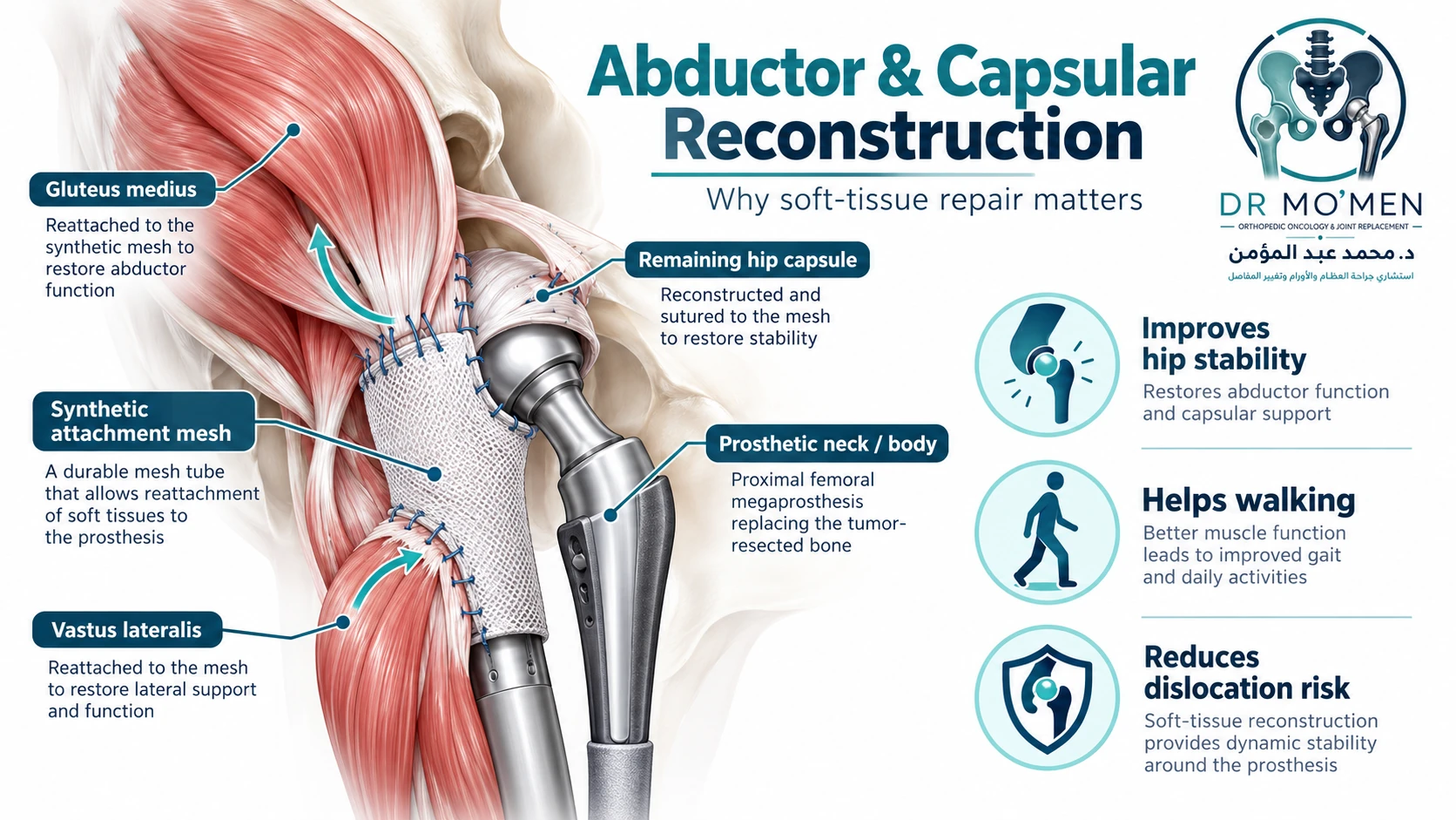 Diagram of abductor and capsular reconstruction around a proximal femoral megaprosthesis using synthetic attachment mesh.