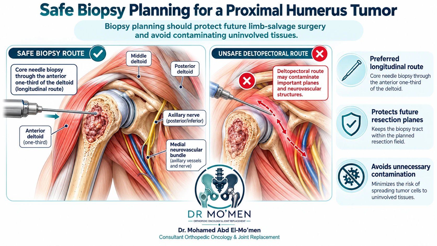 Educational anatomy diagram showing planned core needle biopsy for a proximal humerus tumor while protecting future resection planes and neurovascular structures.