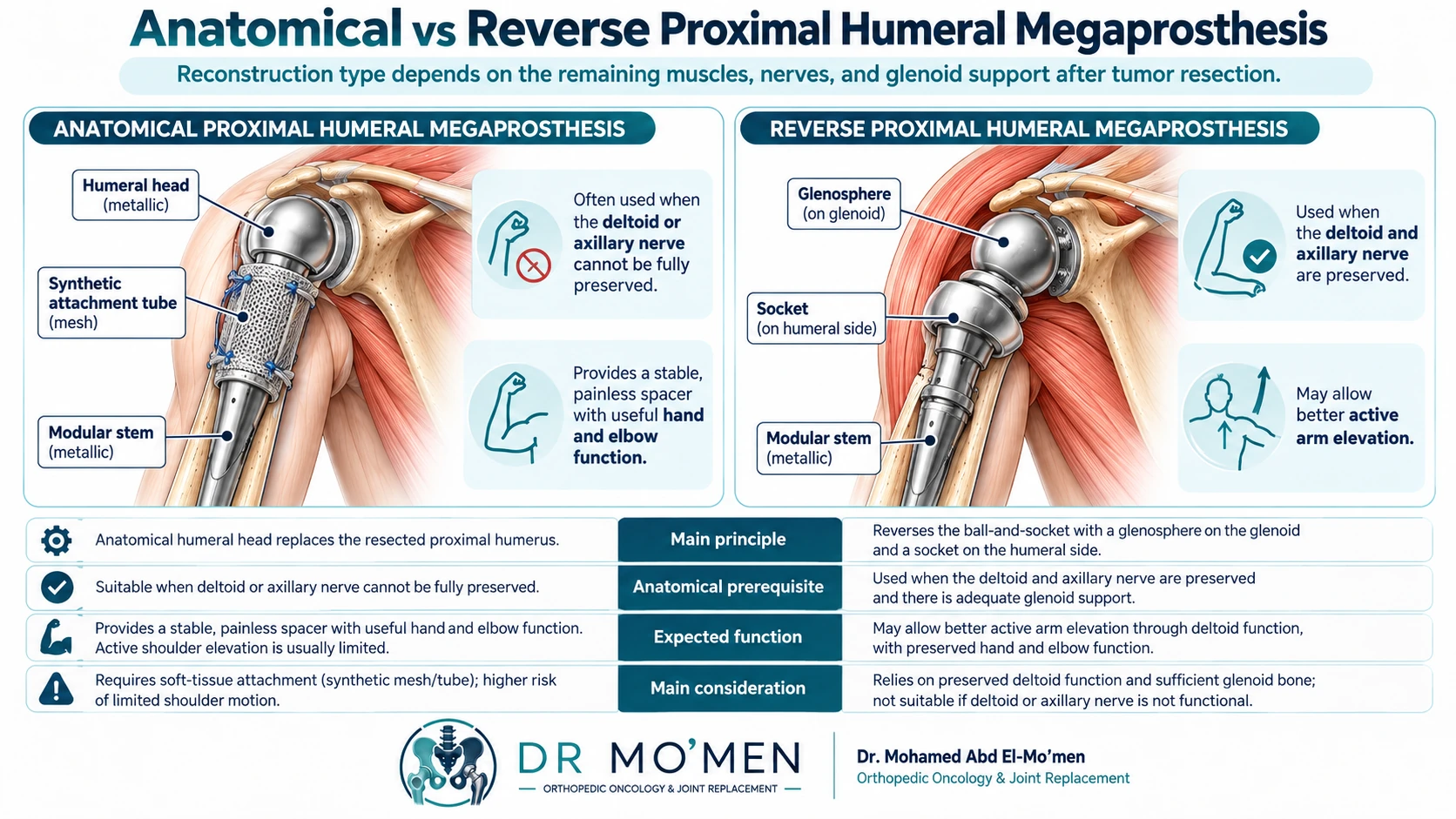 Side-by-side educational comparison of anatomical and reverse proximal humeral megaprosthetic reconstruction after bone tumor resection.