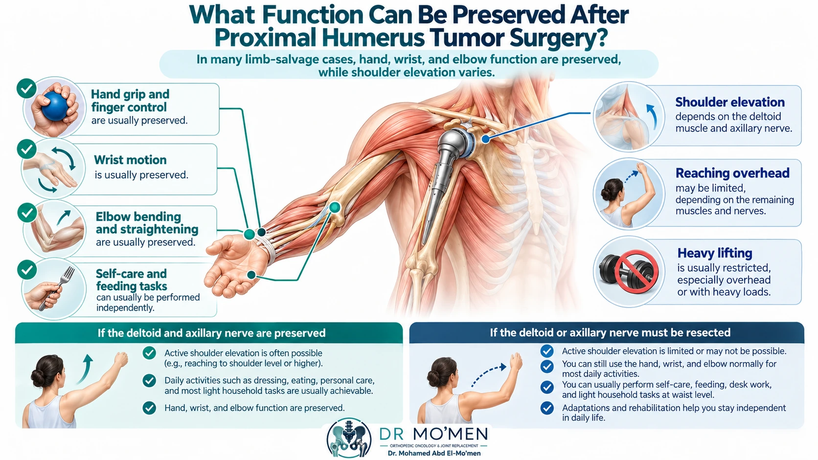 Patient education infographic explaining hand, wrist, elbow and shoulder function after proximal humerus tumor limb-salvage surgery.