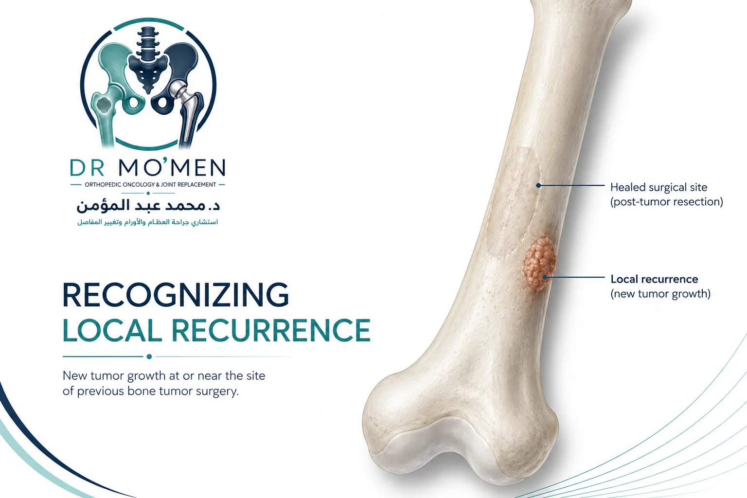 Medical illustration showing a new suspicious lesion at the site of previous bone tumor surgery