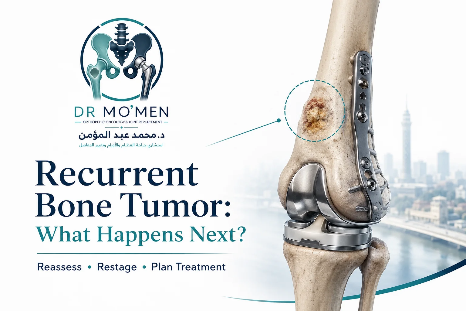 3D orthopedic oncology illustration showing recurrent bone tumor near a previously treated distal femur