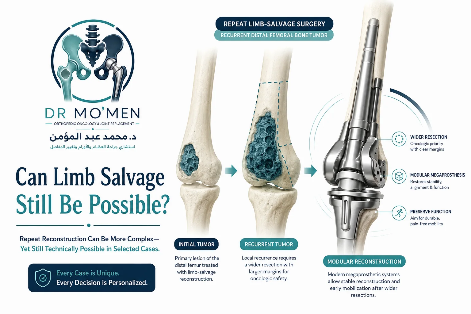 3D illustration showing repeat limb salvage reconstruction after recurrent distal femoral bone tumor