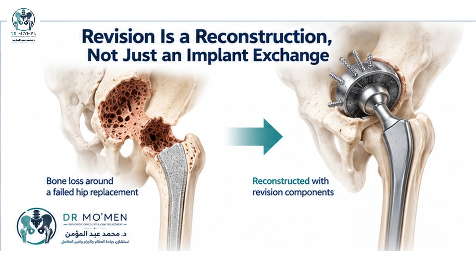 Revision Is a Reconstruction, Not Just an Implant Exchange 3D illustration showing bone loss around a failed hip replacement reconstructed with specialized revision components.
