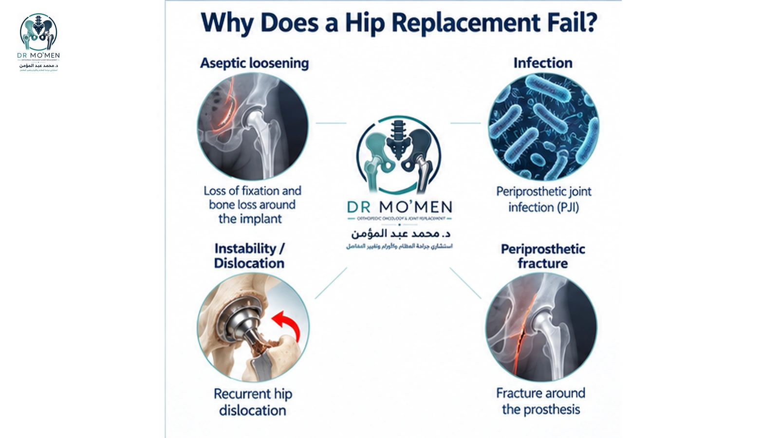 Why Does a Hip Replacement Fail? Medical illustration showing loosening, infection, instability and periprosthetic fracture as causes of failed hip replacement.