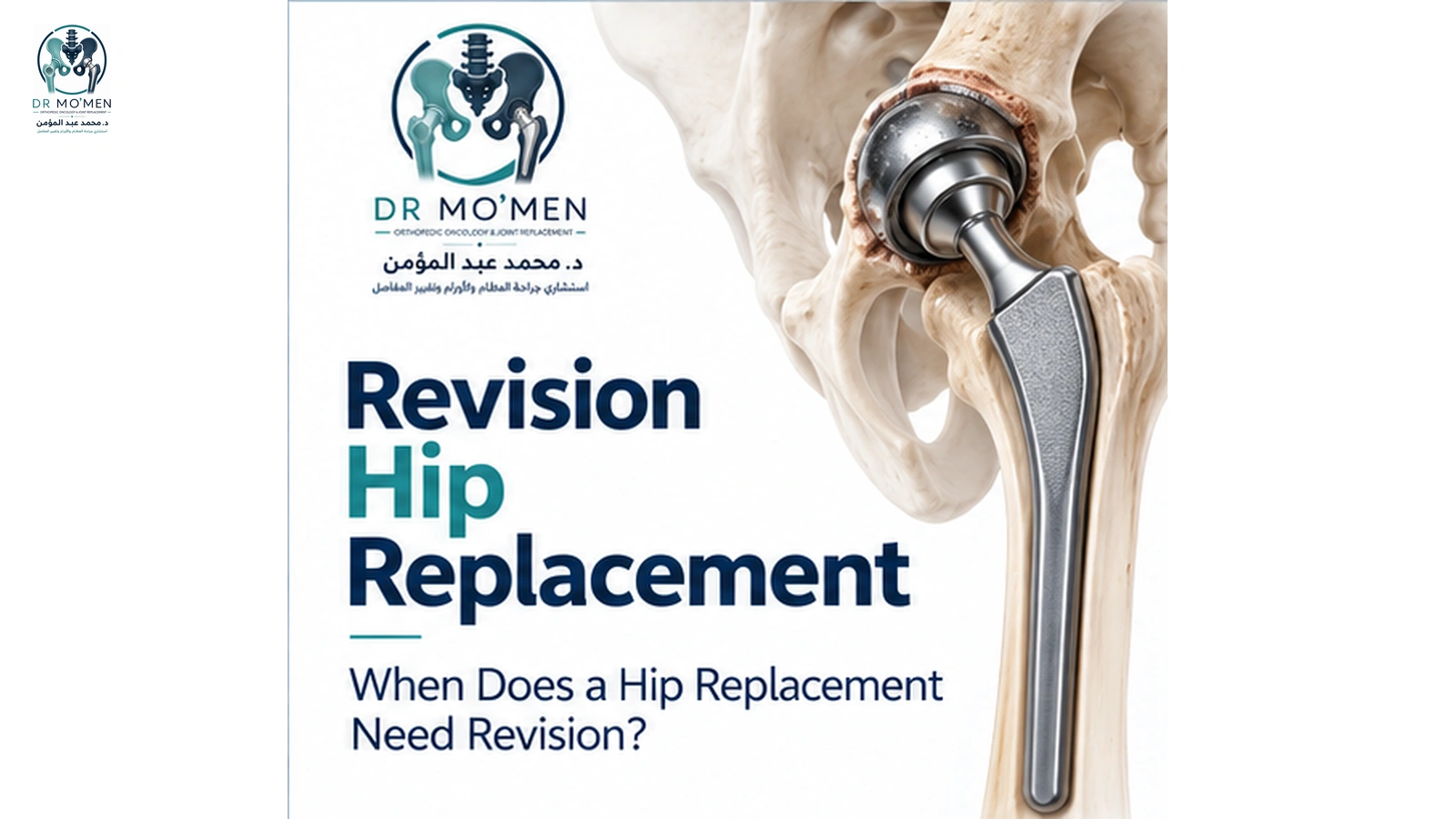 Revision Hip Replacement 3D medical illustration showing a complex revision total hip replacement with revision components and reconstructed bone.