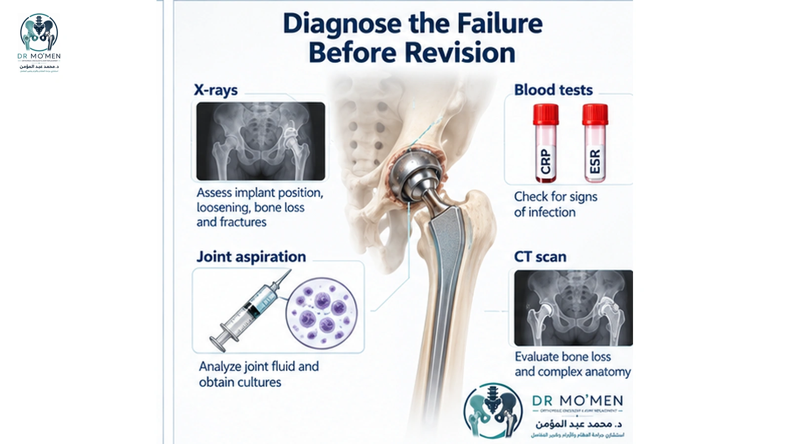 Diagnose the Failure Before Revision Infographic illustrating X-rays, blood tests, joint aspiration and CT used when evaluating a failed hip replacement.