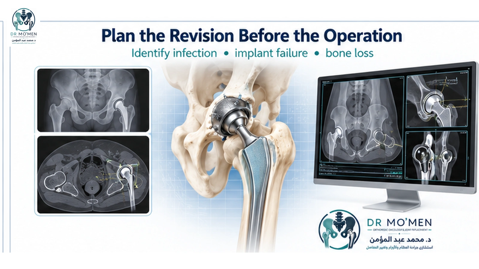 Plan the Revision Before the Operation Medical visualization of revision hip replacement planning using radiographs, CT imaging and a reconstructed hip prosthesis.