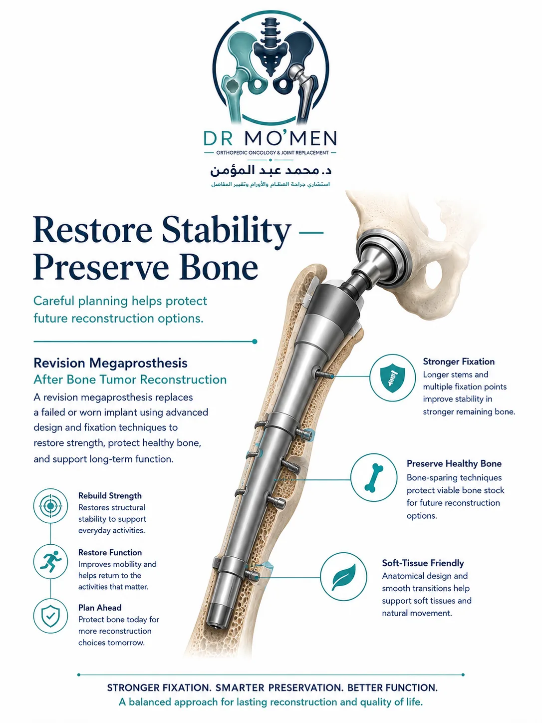 Revision megaprosthesis using stable fixation in remaining healthy bone while preserving bone stock