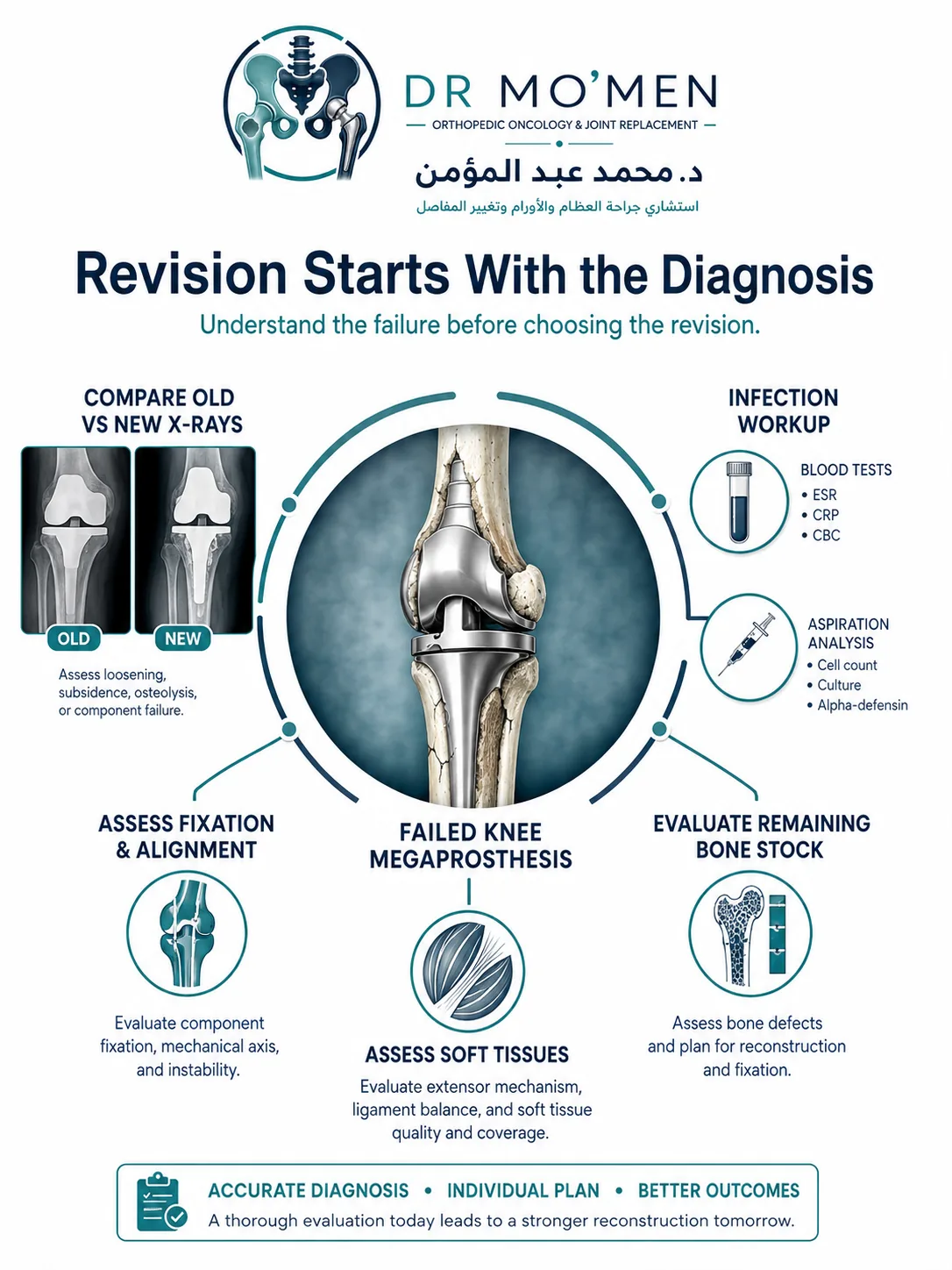 Preoperative planning for megaprosthesis revision including old X-rays infection assessment and bone stock