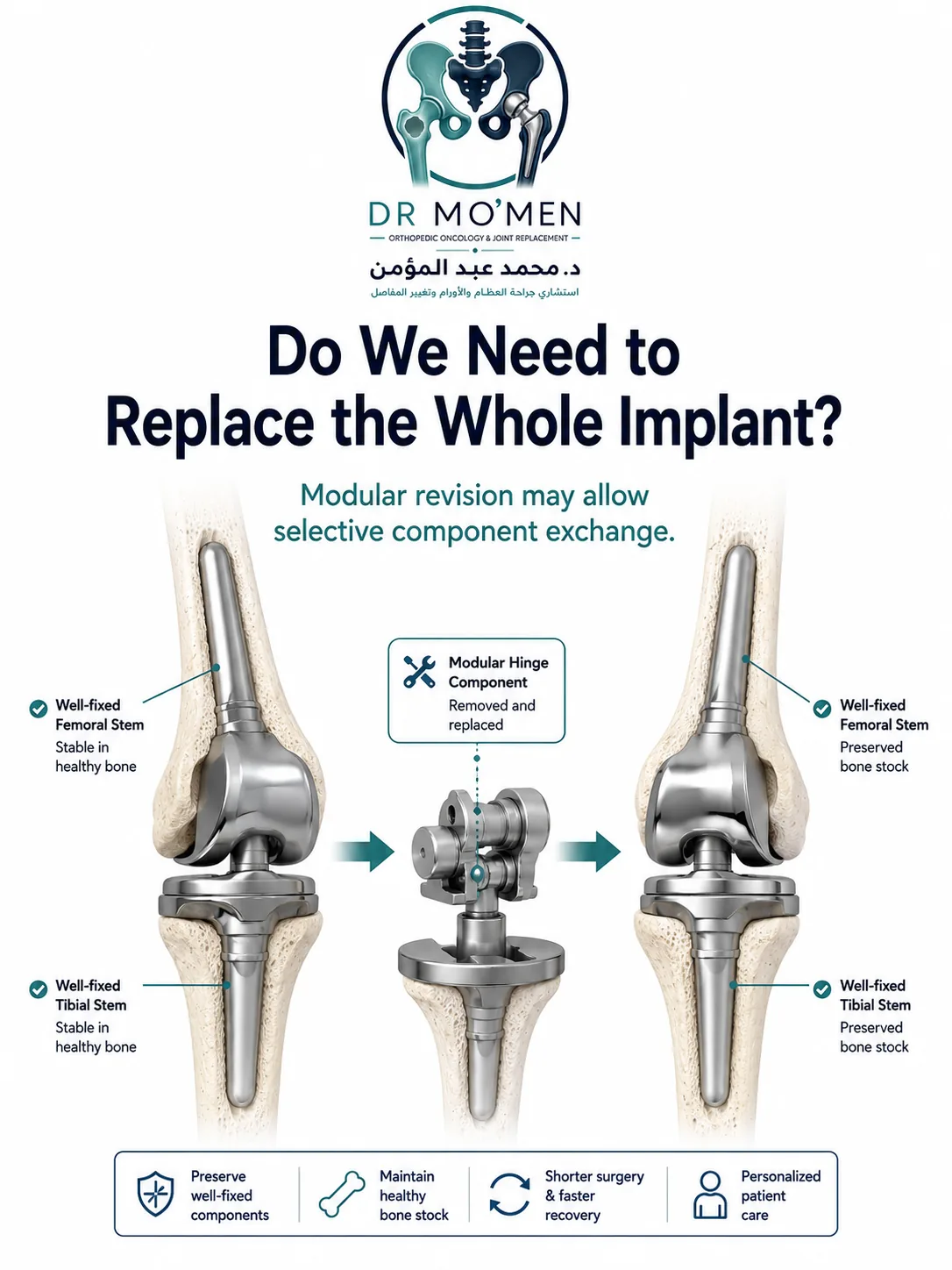 Modular component exchange while preserving well-fixed megaprosthesis stems