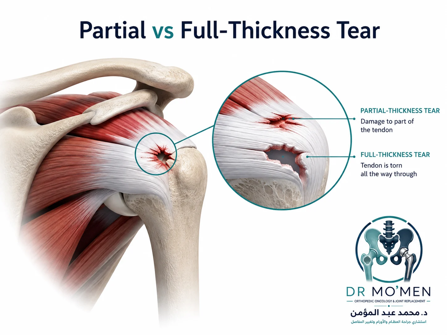 Medical illustration explaining partial-thickness and full-thickness rotator cuff tears in the shoulder tendon.