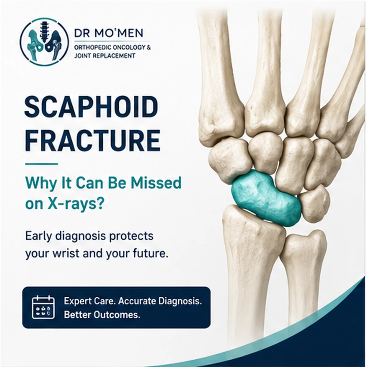 3D wrist anatomy highlighting the scaphoid bone in an educational poster about fractures missed on early X-rays