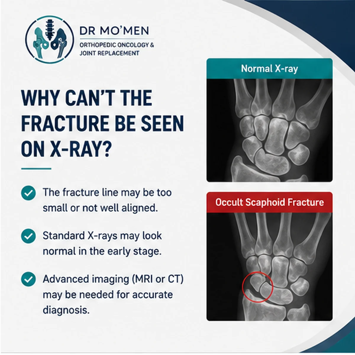 Medical infographic explaining why a scaphoid fracture may be occult on initial X-rays and when MRI or CT may help