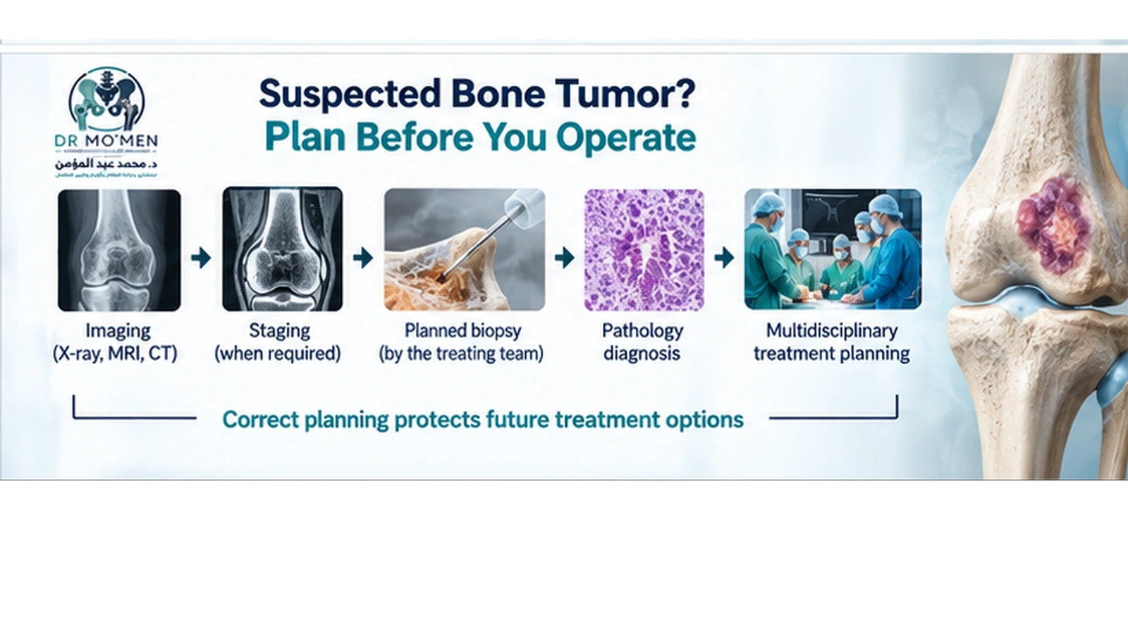 Suspected Bone Tumor? Plan Before You Operate Medical illustration showing the correct diagnostic sequence for a suspected bone tumor before biopsy or surgery.