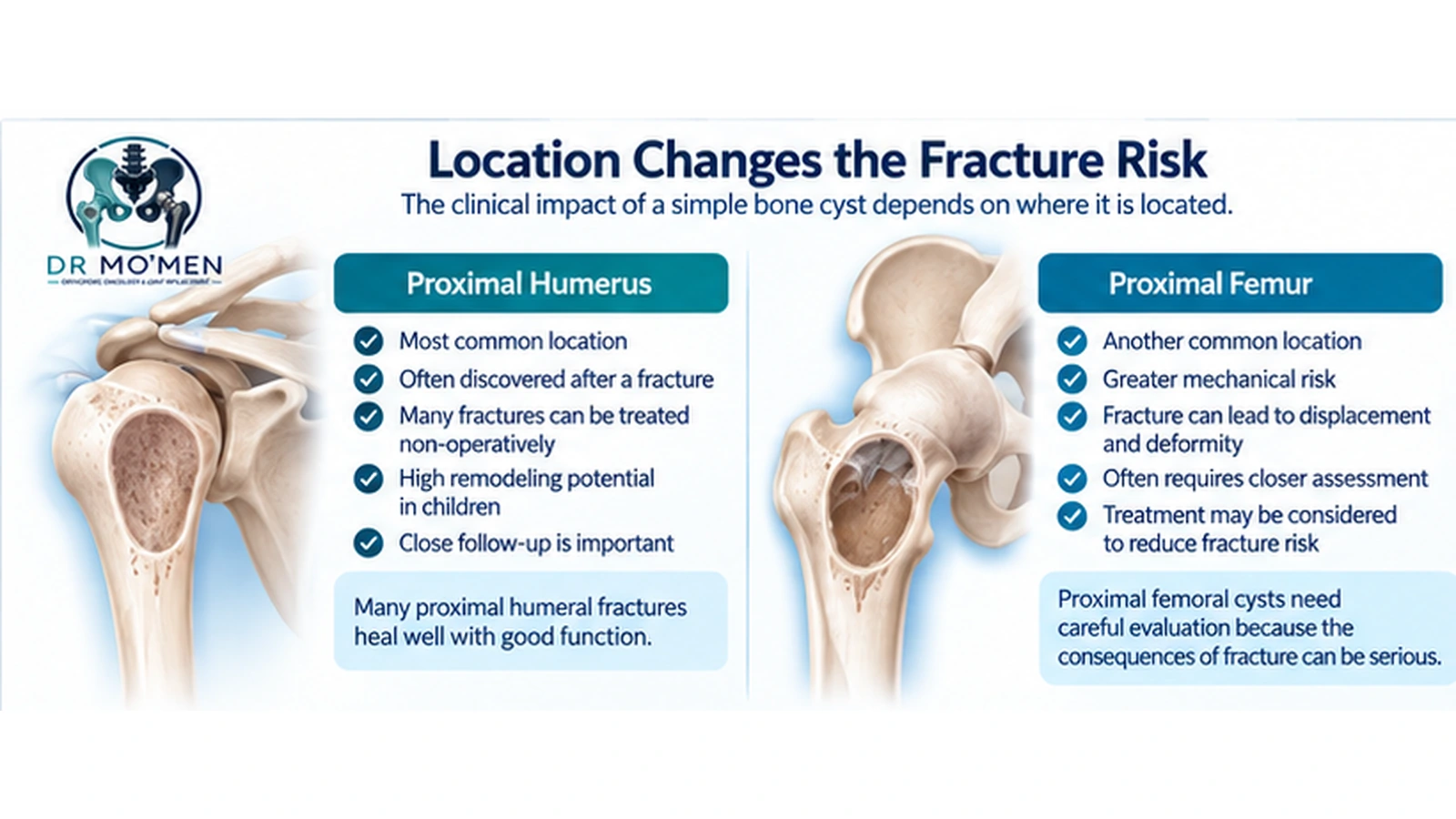 Location Changes the Fracture Risk Medical infographic comparing a simple bone cyst in the proximal humerus with one in the proximal femur and explaining why treatment decisions differ.