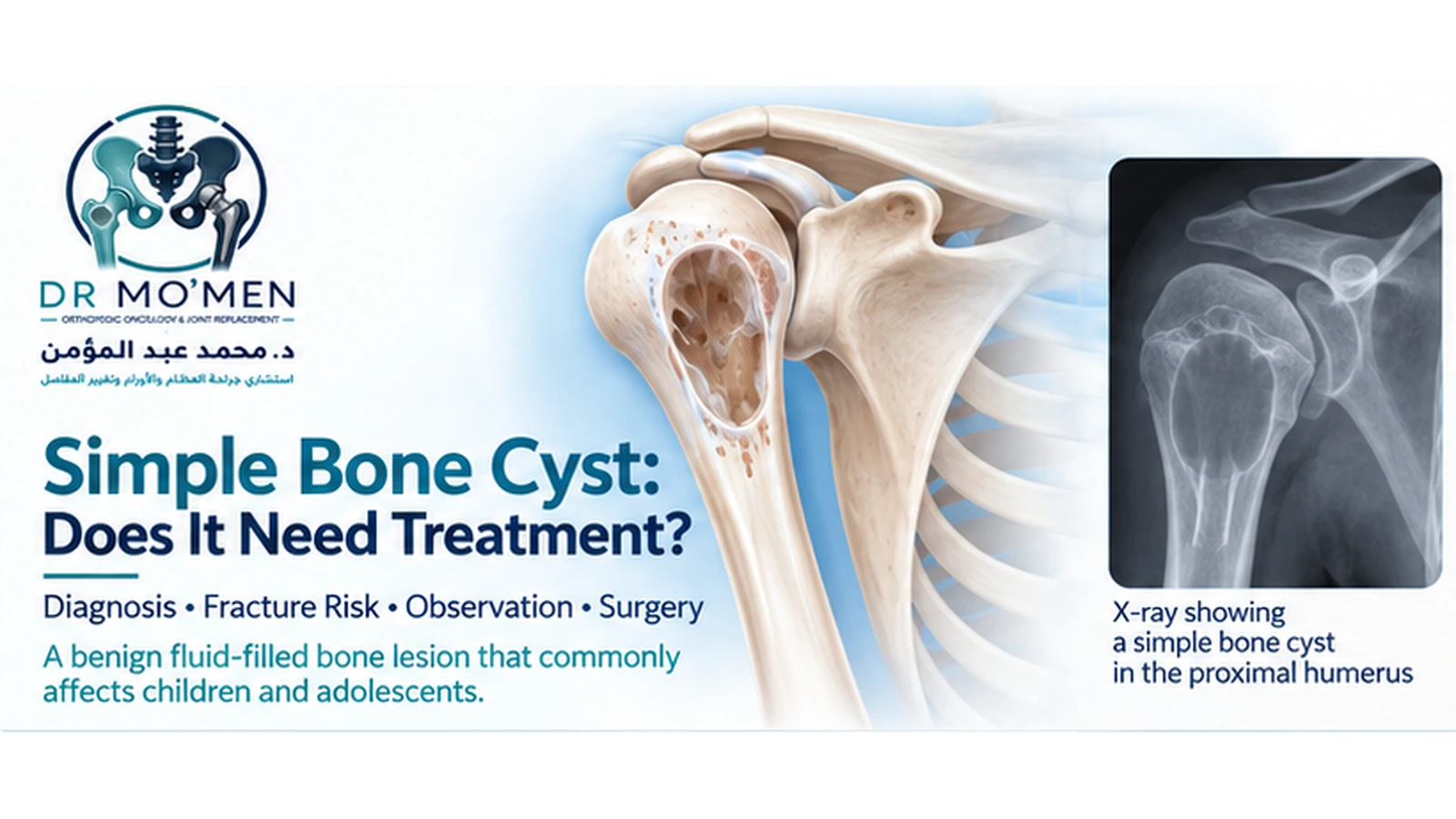 Simple Bone Cyst: Does It Need Treatment? Scientifically accurate medical illustration showing a unicameral bone cyst in the proximal humerus with cortical thinning.