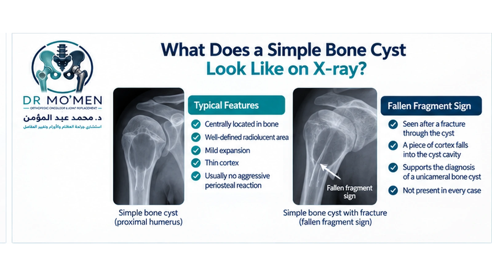 What Does a Simple Bone Cyst Look Like? Radiology illustration showing a centrally located unicameral bone cyst and the fallen fragment sign after pathological fracture.