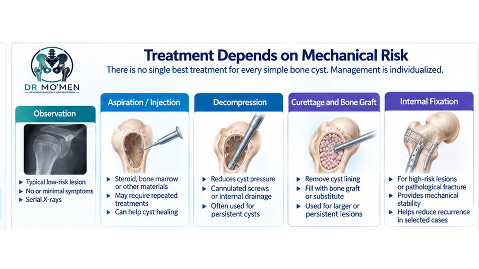 Treatment Depends on Mechanical Risk Infographic showing observation, injection, decompression, curettage and fixation as selected treatment options for unicameral bone cysts.