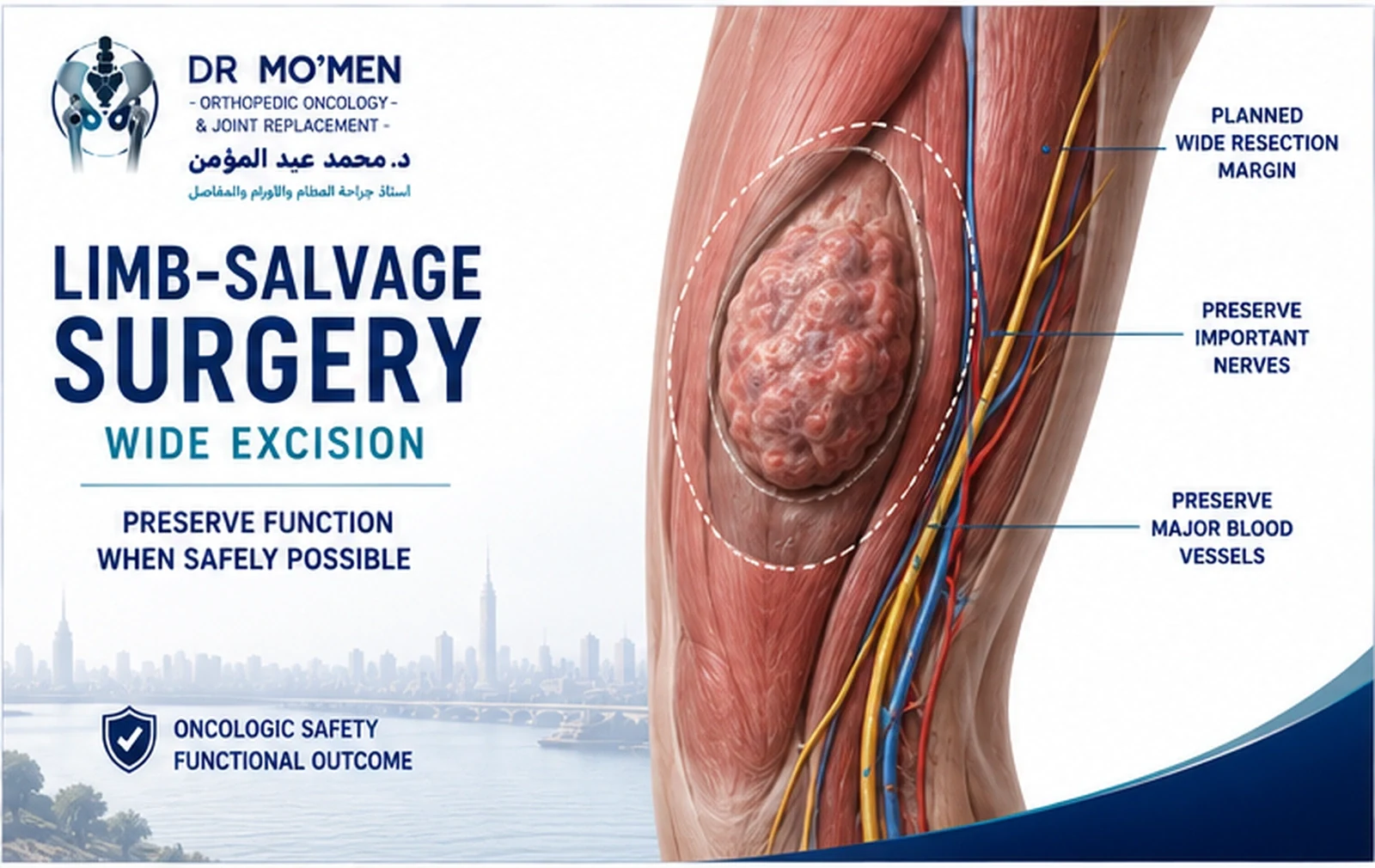 3D illustration showing planned wide excision of a thigh soft-tissue sarcoma while preserving important nerves and vessels