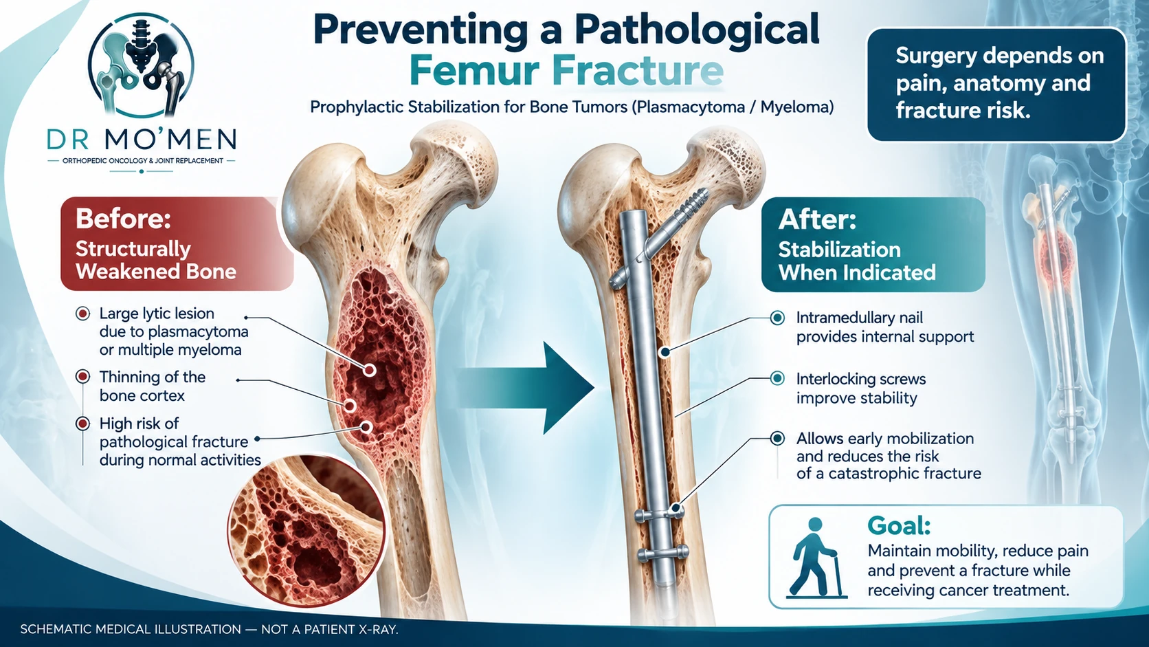 Illustration comparing an unstable osteolytic femoral lesion with selected prophylactic intramedullary nail stabilization.