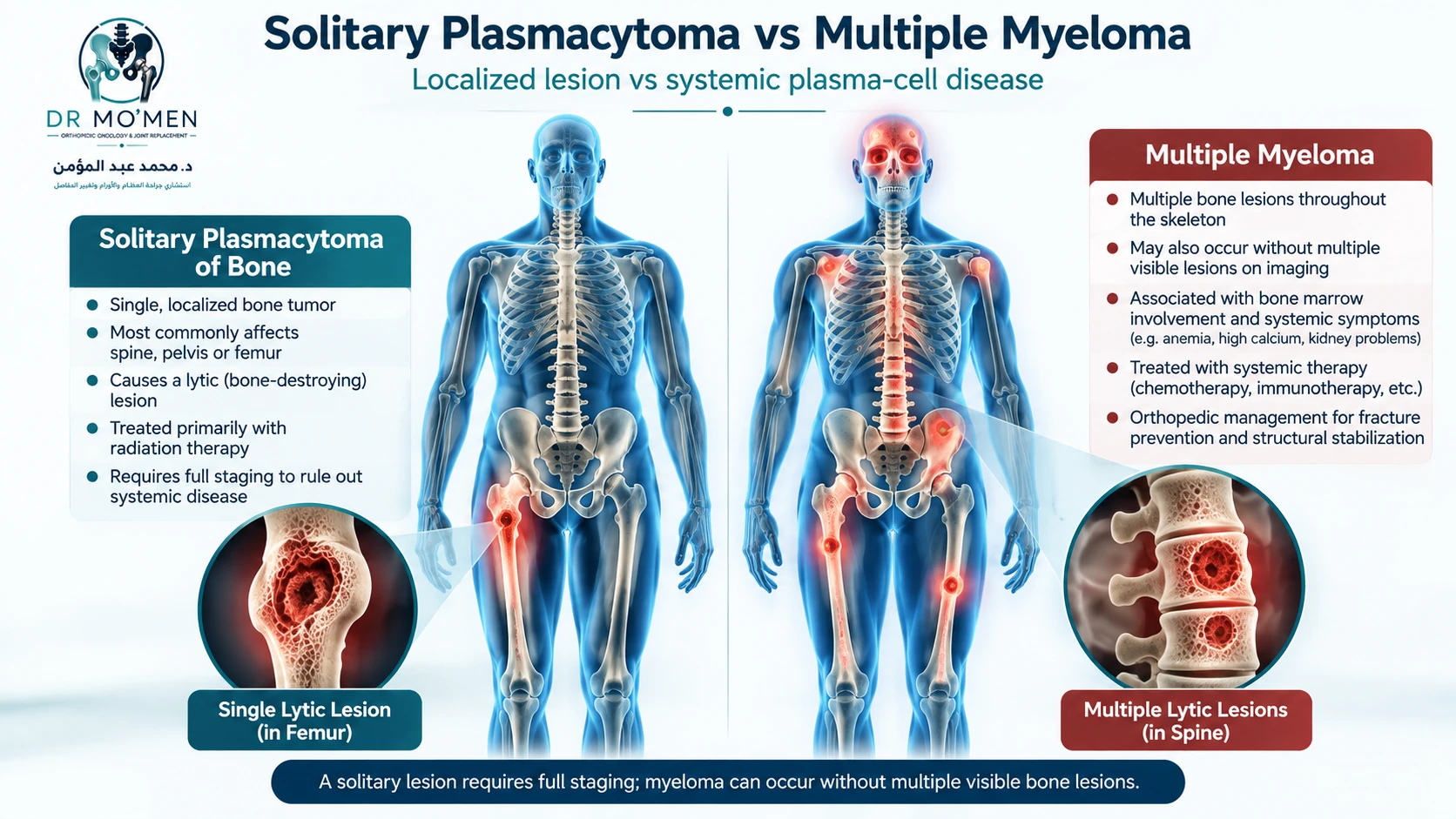 Medical illustration contrasting a single biopsy-proven solitary bone plasmacytoma with systemic multiple myeloma and several skeletal lesions.