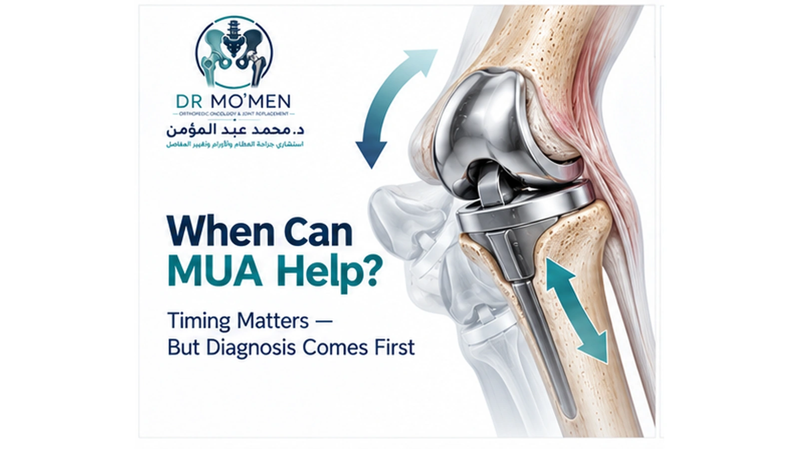 When Can MUA Help? 3D medical illustration explaining manipulation under anesthesia after knee replacement.
