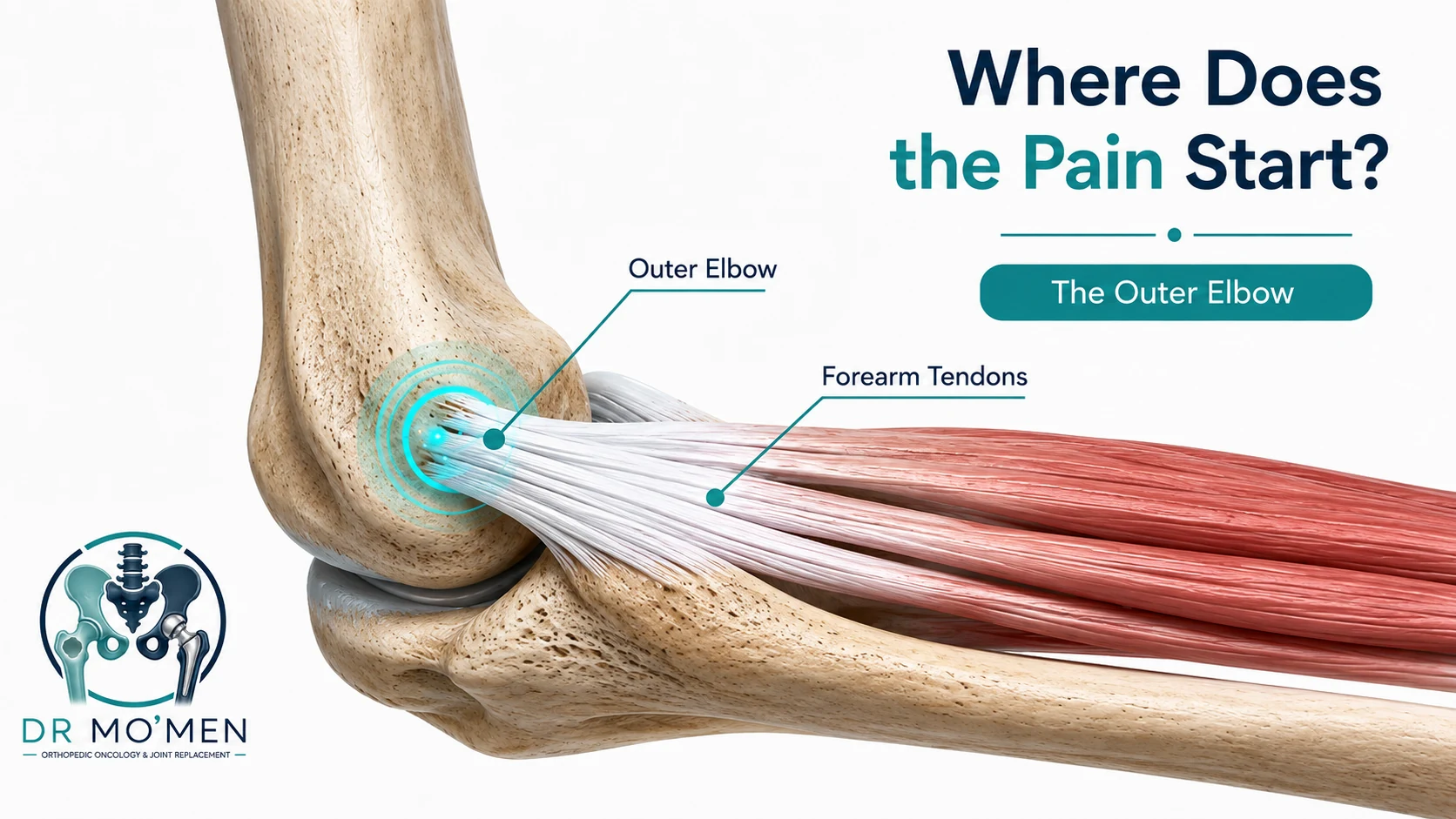 Elbow anatomy illustration showing the forearm tendons and their attachment at the outer elbow in tennis elbow.