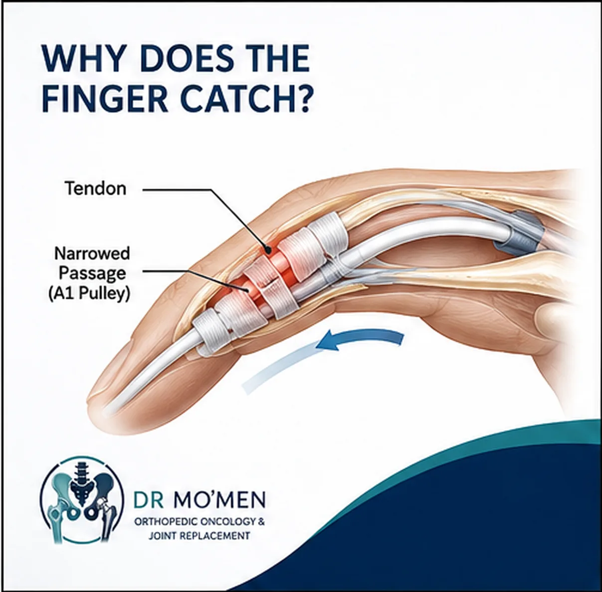Medical illustration showing the flexor tendon and narrowed A1 pulley in trigger finger.