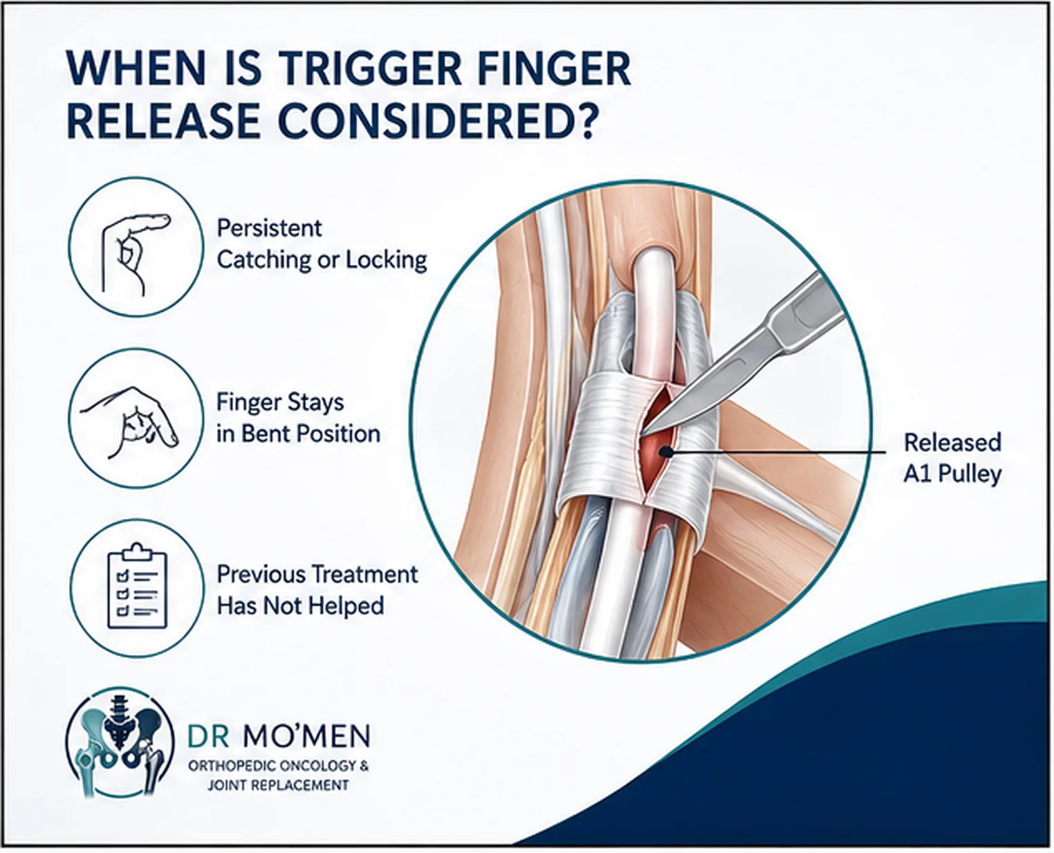 Medical infographic explaining when trigger finger release may be considered for persistent or severe locking.