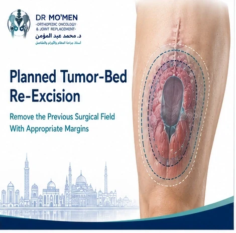 3D medical illustration explaining planned tumor-bed re-excision after an unplanned soft-tissue sarcoma removal