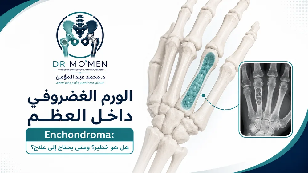 ورم غضروفي داخل عظام اليد Enchondroma — تقييم وعلاج