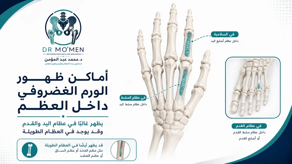 مكان ظهور Enchondroma في أصابع اليد وعظام المشط