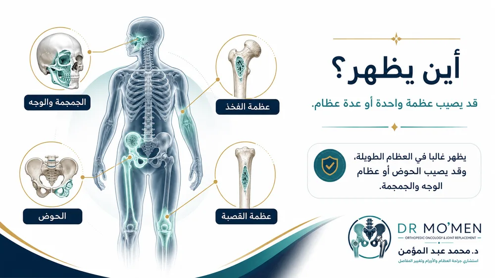 خلل التنسج الليفي العظمي Fibrous Dysplasia — صورة توضيحية داخل المقال رقم 2