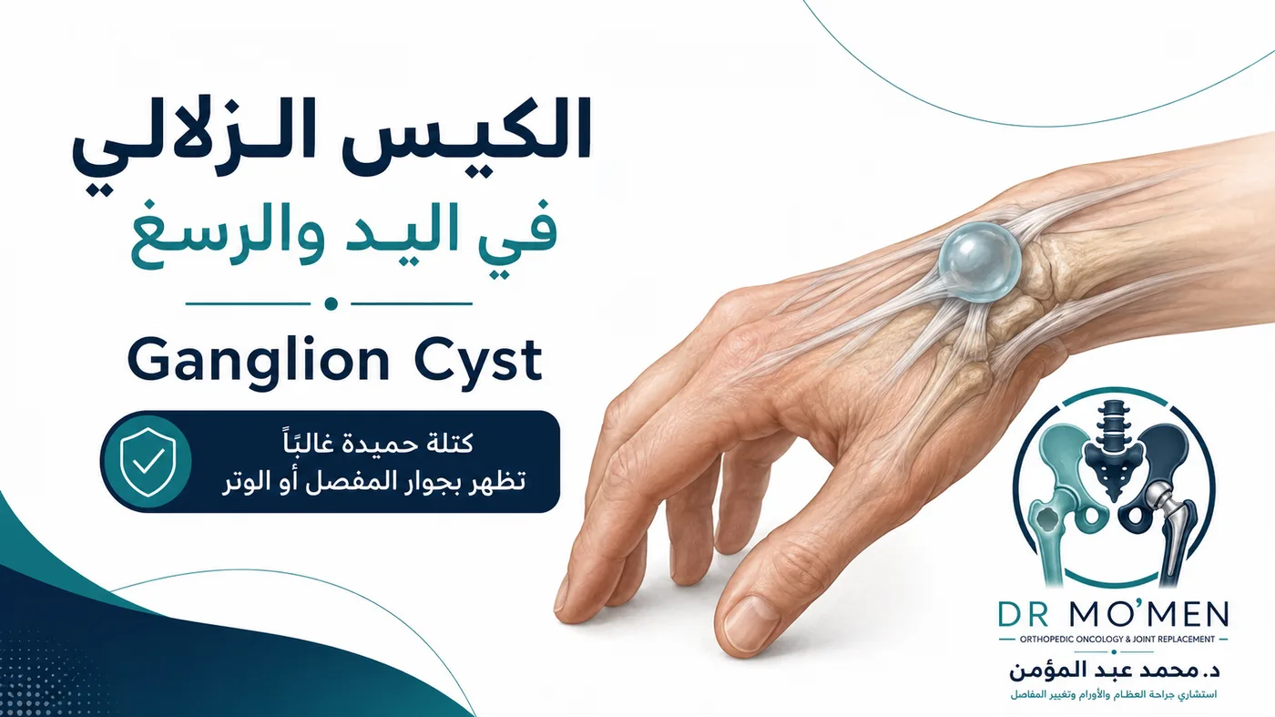 الكيس الزلالي في اليد والرسغ: هل هو خطير؟ ومتى يحتاج إلى علاج؟ — غلاف مقال طبي