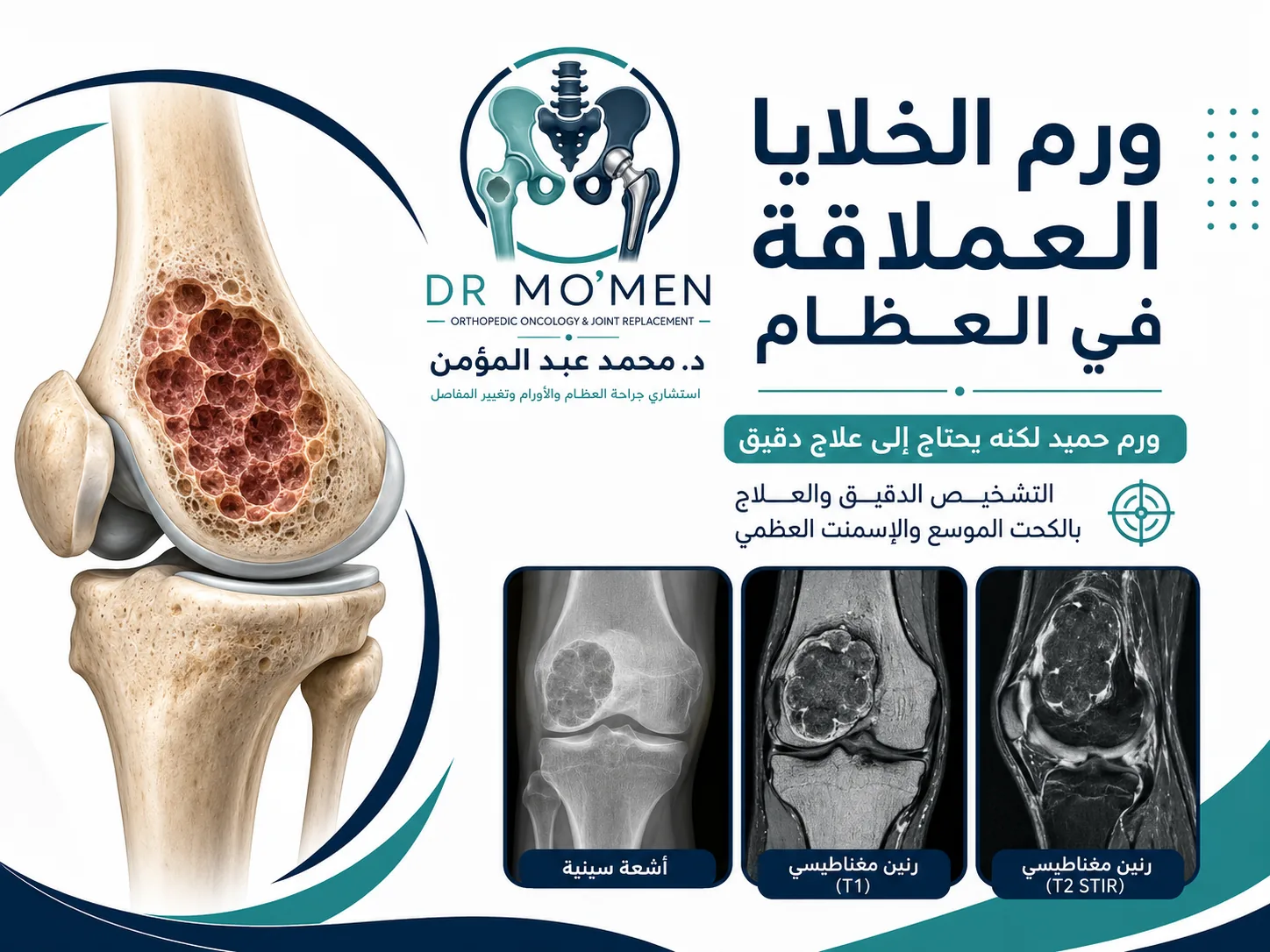 ورم الخلايا العملاقة في العظام وعلاجه بالكحت الموسع والإسمنت العظمي