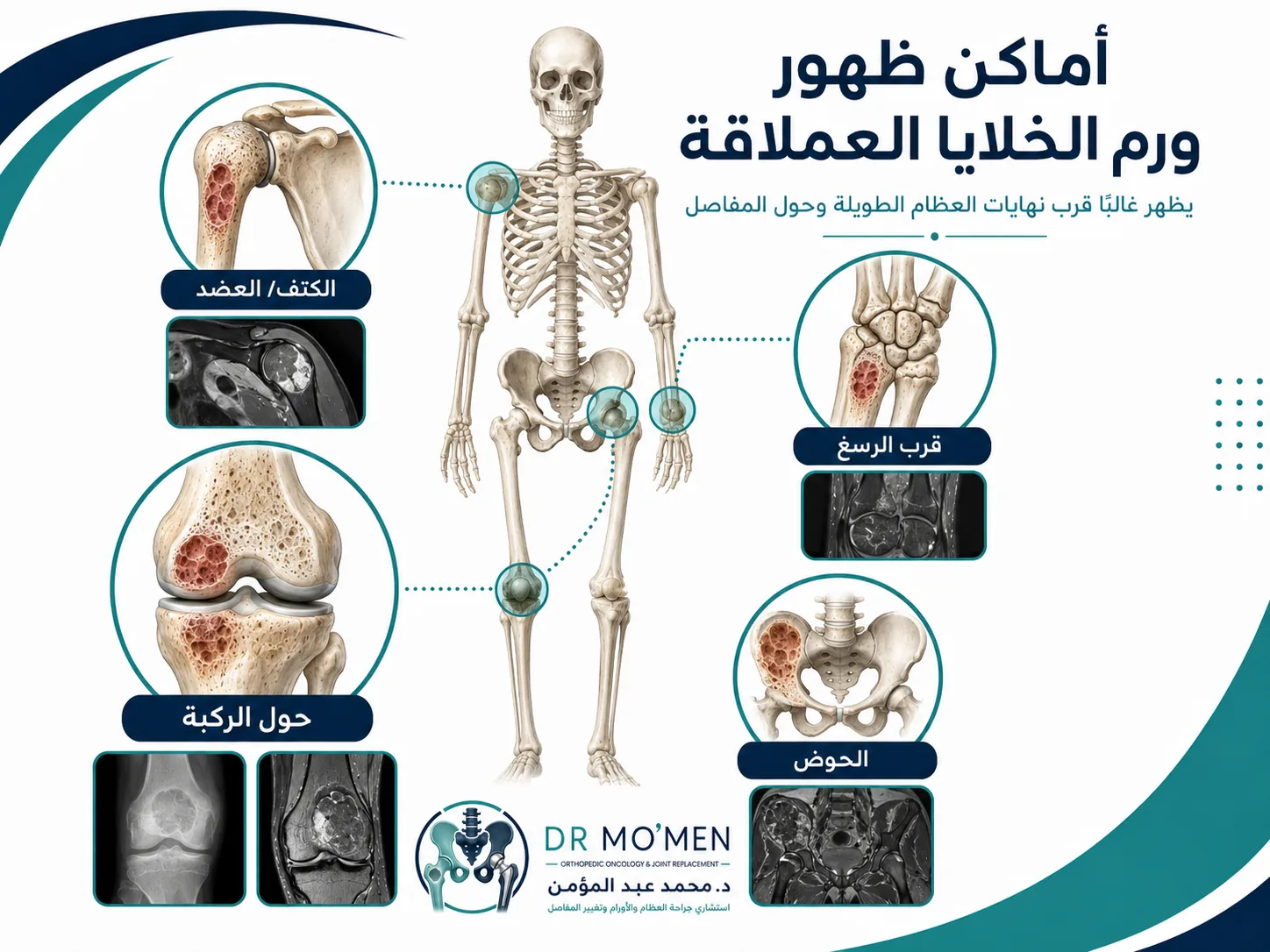 أماكن ظهور ورم الخلايا العملاقة قرب المفاصل مثل الركبة والرسغ