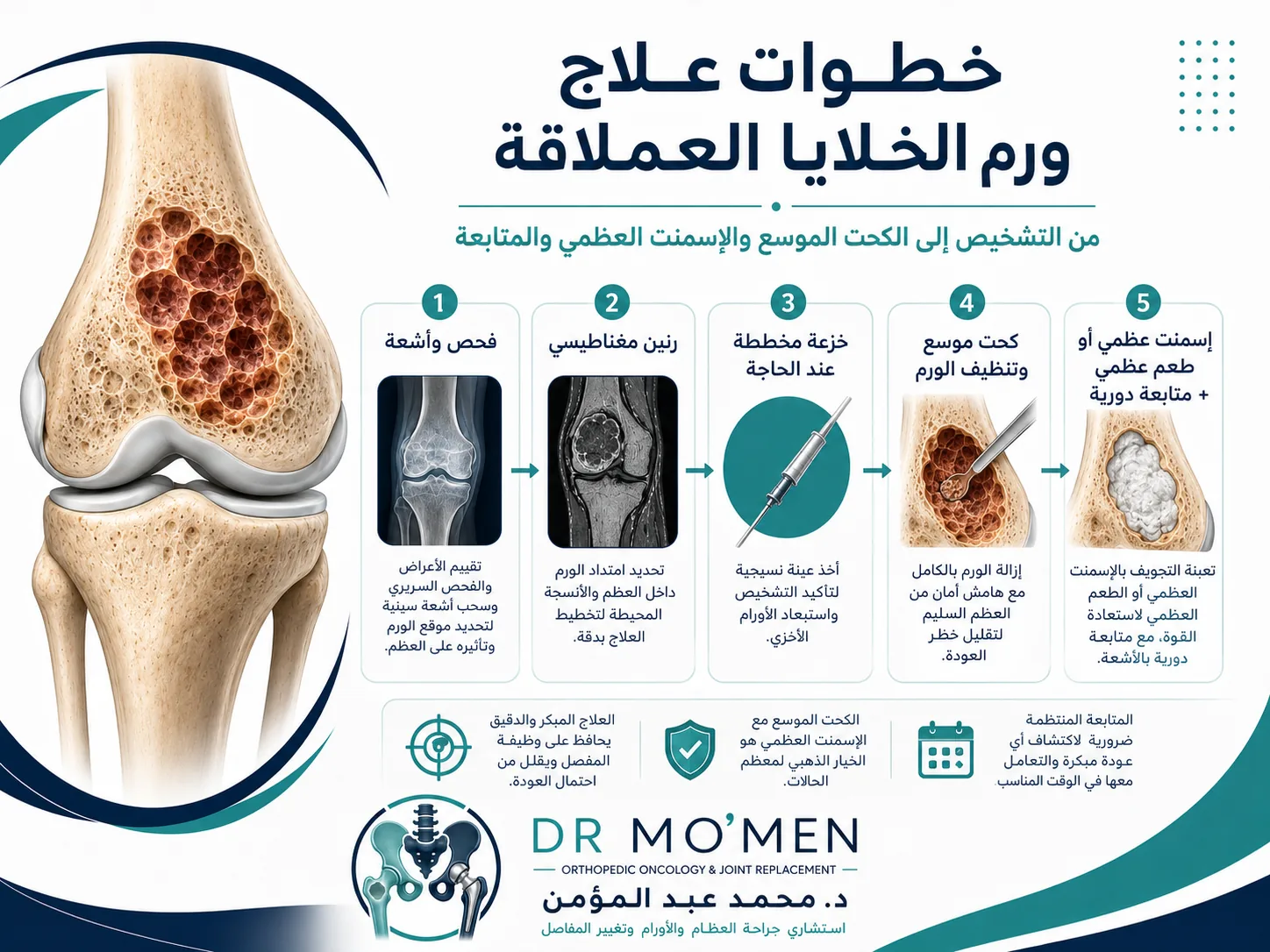 خطوات علاج ورم الخلايا العملاقة من التشخيص إلى الكحت الموسع والإسمنت والمتابعة