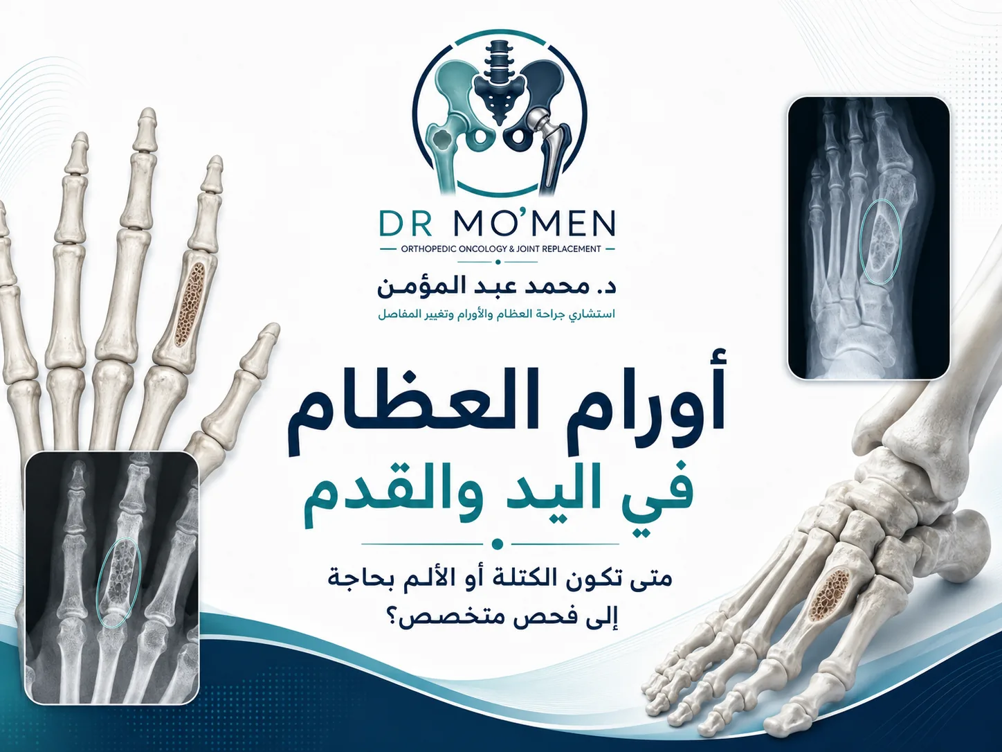 أورام العظام في اليد والقدم ومتى تكون الكتلة أو الألم بحاجة إلى فحص متخصص