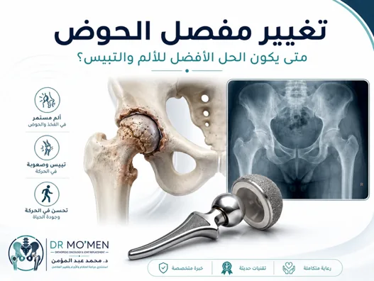 تغيير مفصل الحوض لعلاج خشونة مفصل الفخذ ونخر رأس عظمة الفخذ وتحسين الحركة